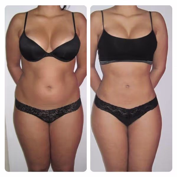 Liposuction in Turkey